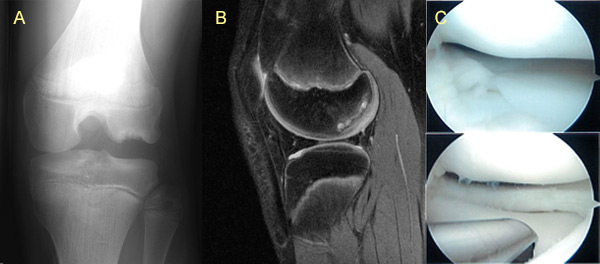 OrthoKids Osteochondritis Dissecans (OCD)