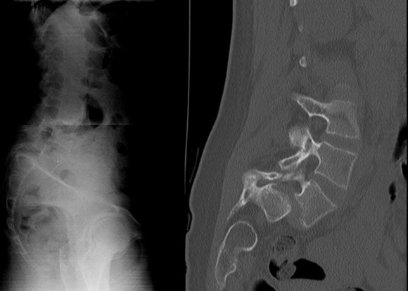 Spondylolisthesis