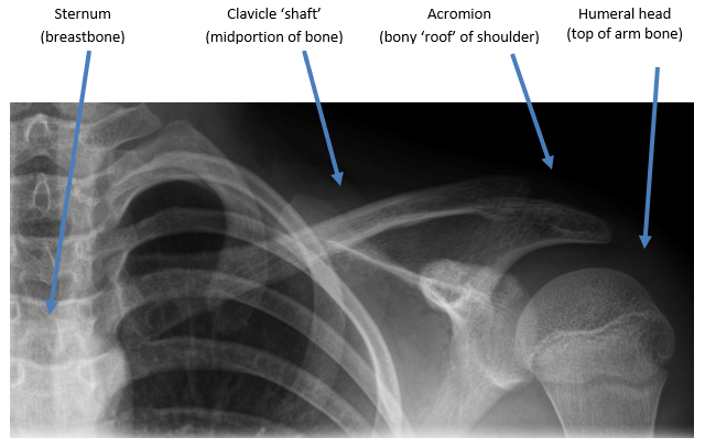 Proximal Clavicle Fracture