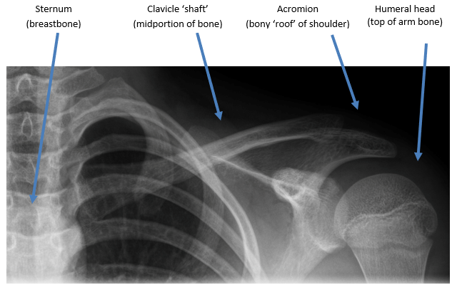 clavicle bone x ray