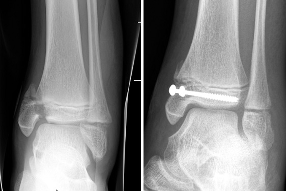 Ankle fracture before and after surgery
