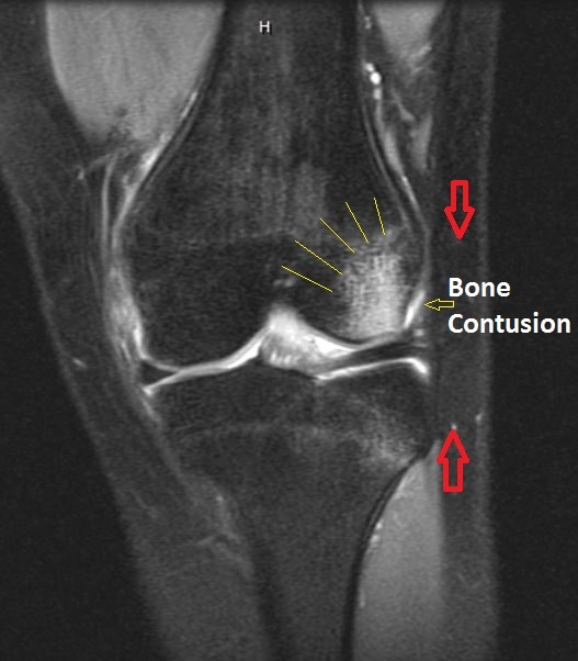 OrthoKids Basketball Injuries