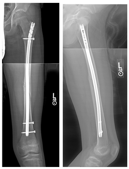 x rays of broken femur