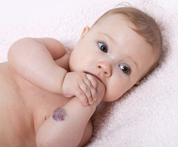 Hemangioma in Infant