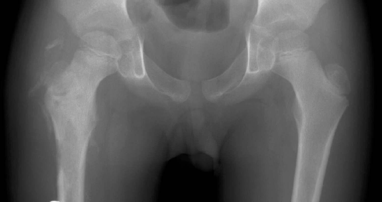 Hip Infection of Bone