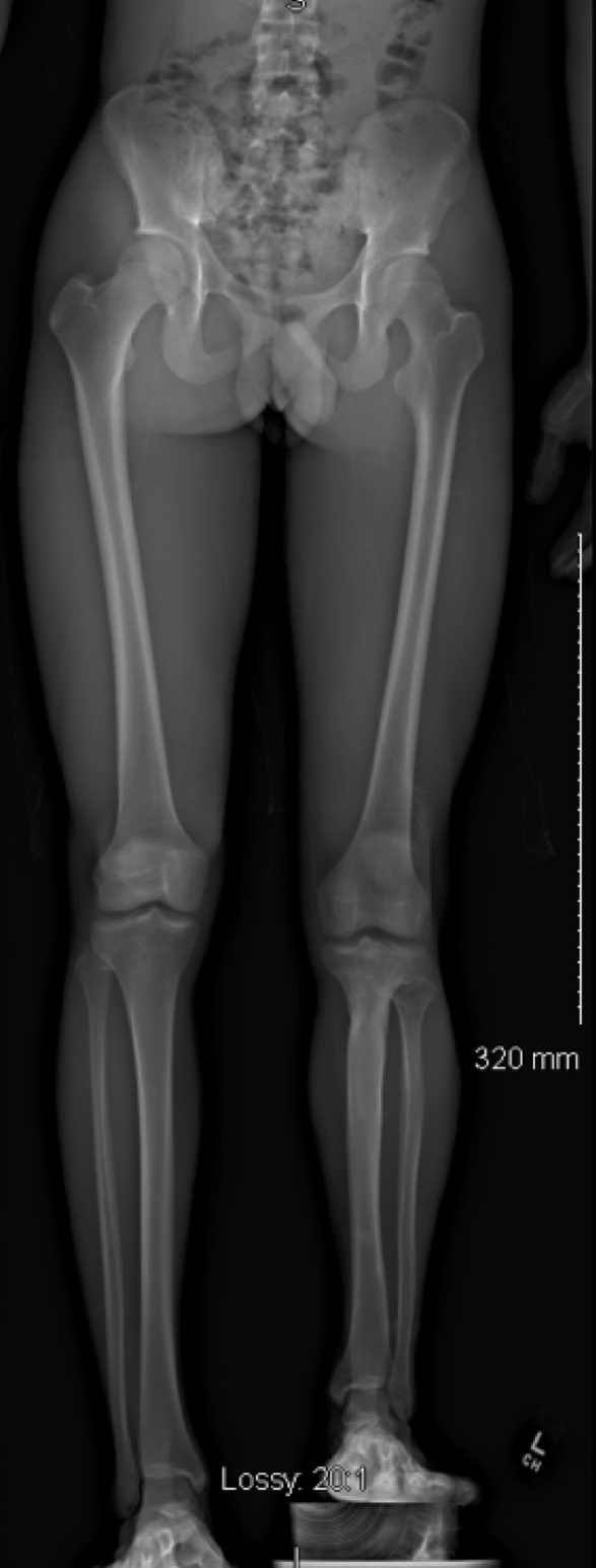 Leg length discrepancy xray