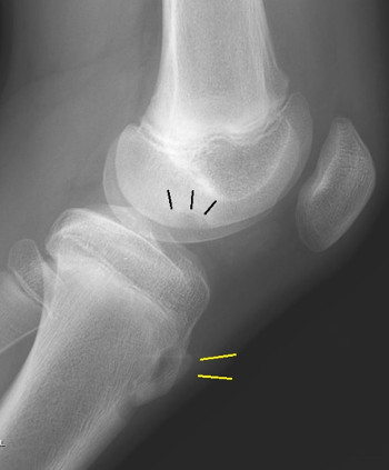 OrthoKids - Osgood-Schlatter's Disease