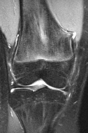 MRI Knee with osteochondroma