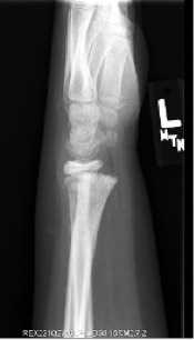 Figure 2: evidence of physeal remodeling 2 months after the cast was taken off.