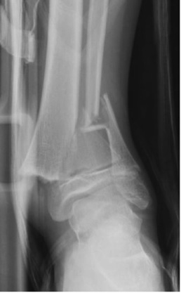 Physeal Fractures