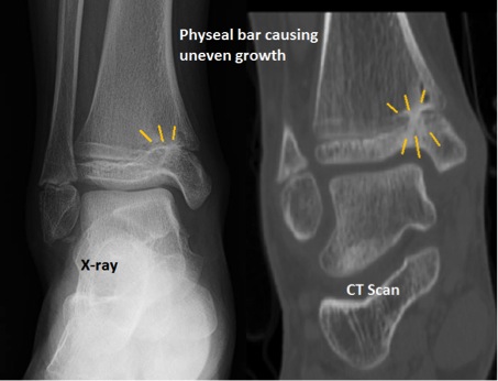 OrthoKids - Ankle Fractures