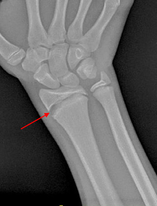 Trauma to the growth plate (red arrow) in the wrist of a gymnast from repet...