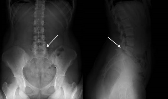 spondylolisthesis x ray