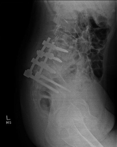 Surgical fixation of Spondy