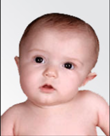 baby with torticollis