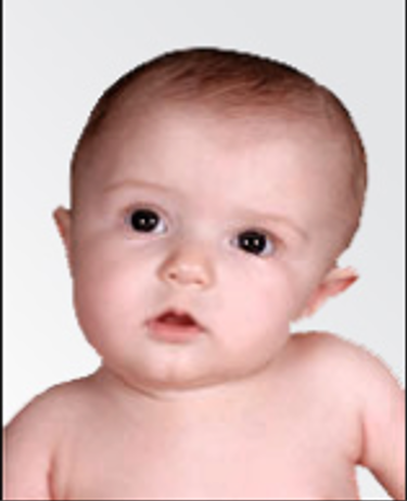 Torticollis Information