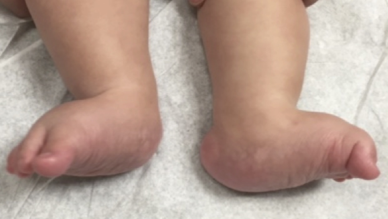 Congenital vertical talus, left foot, in a 5-year-old girl, before