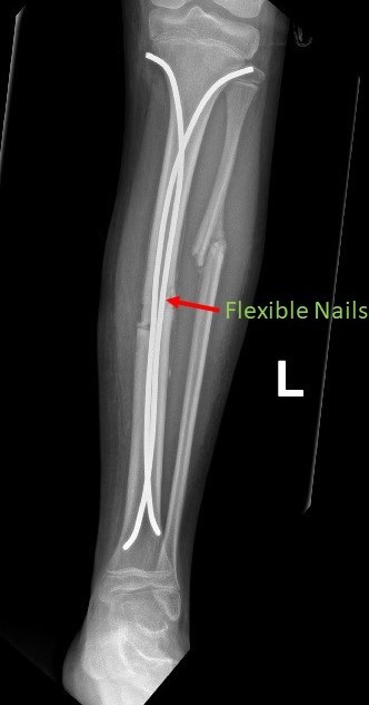 OrthoKids - Tibial Shaft Fractures OrthoKids - Tibial Shaft Fractures