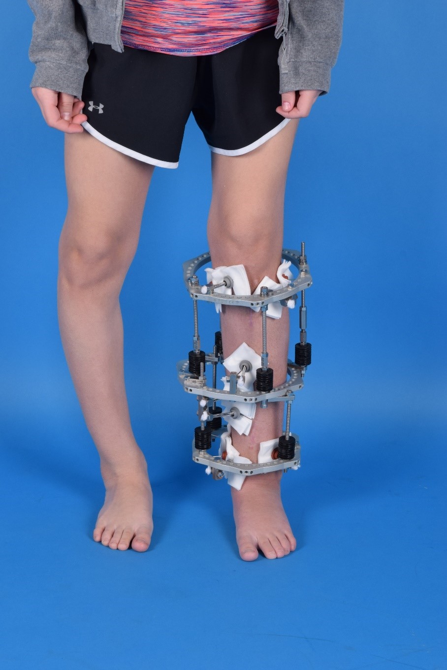 OrthoKids - Bone Stimulator