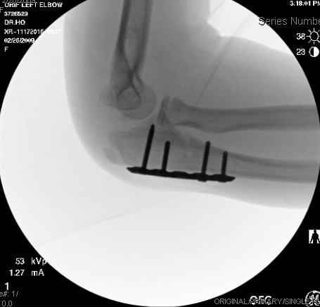 OrthoKids - Bone Stimulator