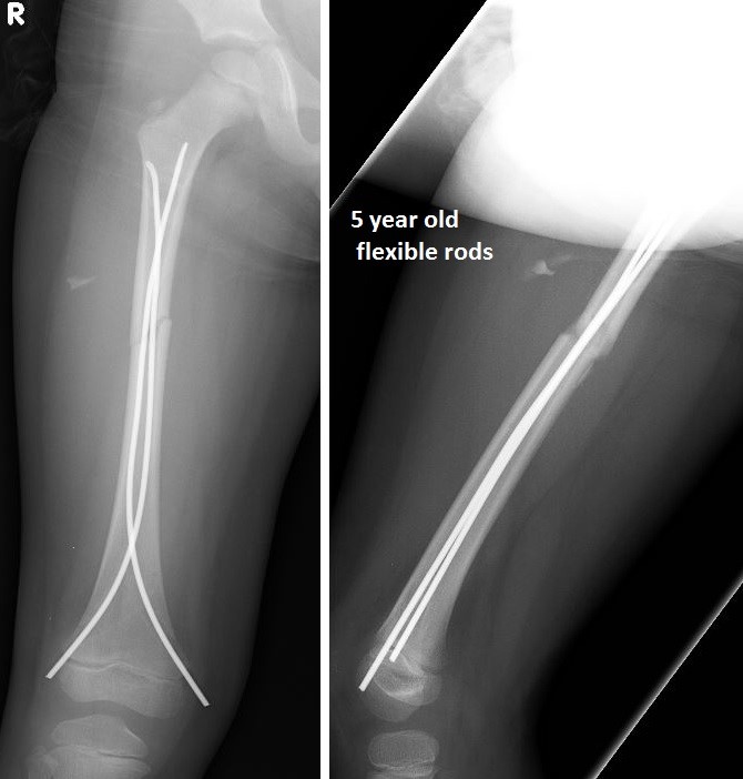 a Distal femoral nonunion after retrograde intramedullary nail of type... |  Download Scientific Diagram