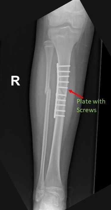 Broken Leg: If my tibial shaft fracture gets surgery, when can I