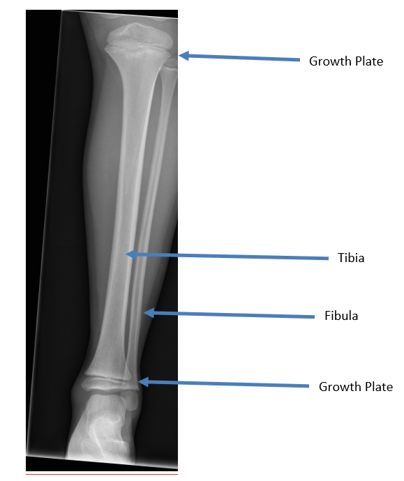 Broken Tibia | Tibial Shaft Fracture Diagnosis & Treatments | ROC