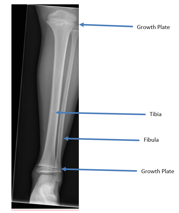 Broken Leg: If my tibial shaft fracture gets surgery, when can I