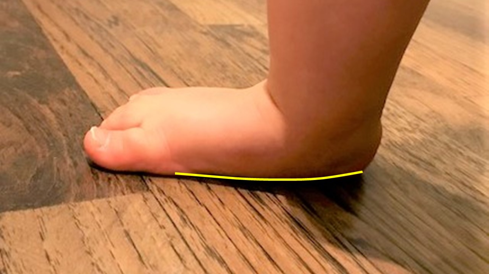 what is flat feet