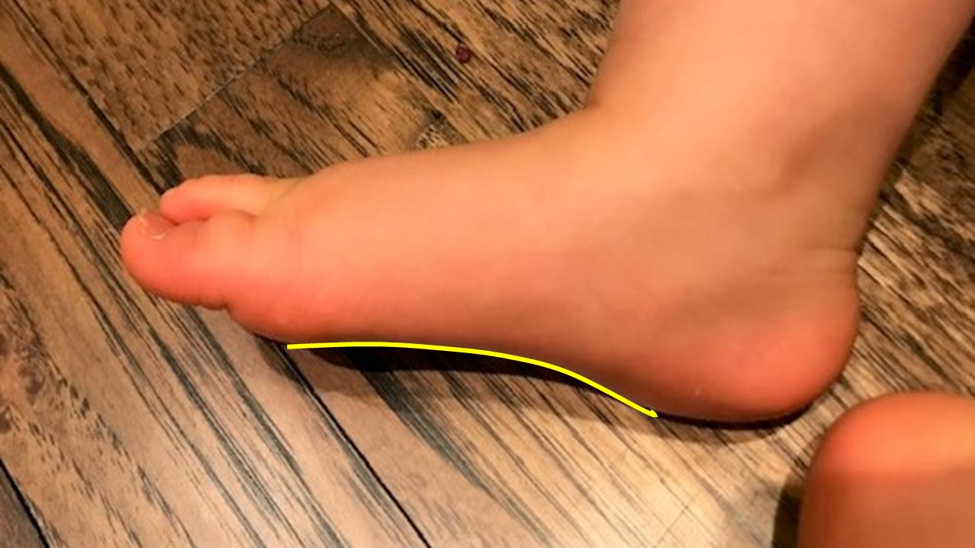 OrthoKids - Flexible Flat Feet