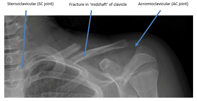 Clavicle Bone X Ray