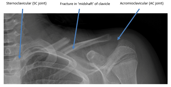 clavicle bone fracture