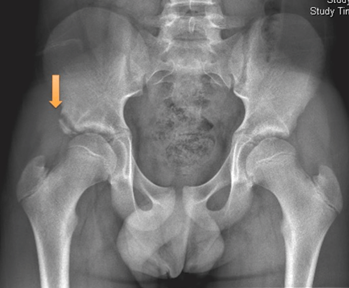 Figure-5-Right-sided-AIIS-avulsion-fracture.png