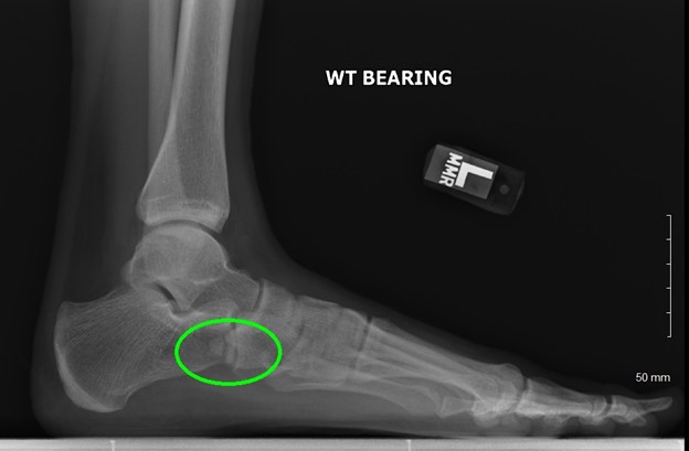 Flexible Flatfoot in Children - OrthoInfo - AAOS