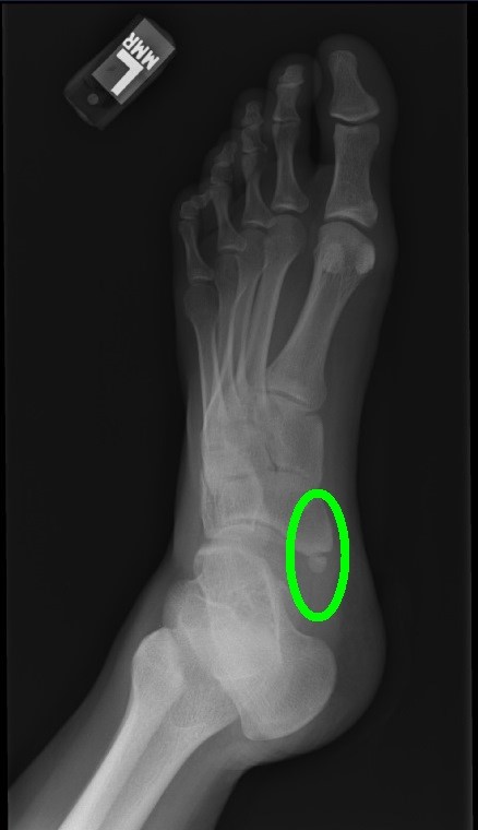 Navicular on sale bone spur