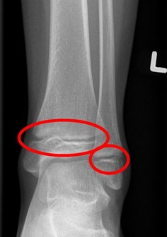 low-energy-ankle-injury-2-png.jpg