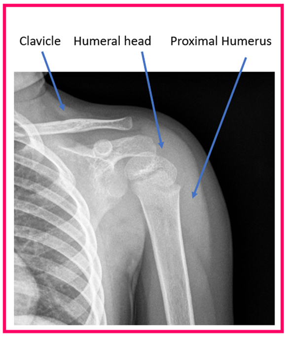 OrthoKids - Proximal Humerus Fractures