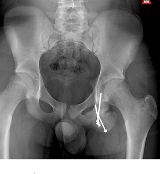 Iliac crest avulsion, Radiology Case