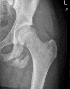 Iliac crest avulsion