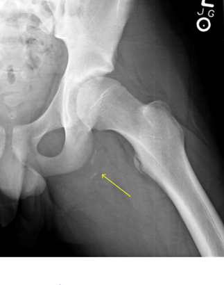 Iliac Crest - Fracture, Apophysis, Graft, Pain - Causes