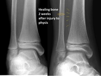Figure 1. First X-ray (on the left) does not show a fracture but the child has pain at the ankle. 2 weeks later, a repeat X-ray shows new bone forming from a fracture in the growth plate.